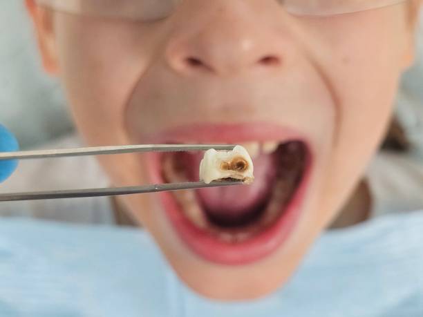 Best Emergency Wisdom Tooth Extraction in Samoset, FL