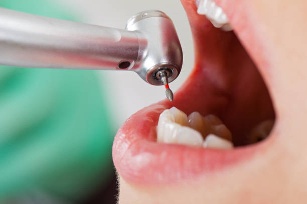Best Lost Filling or Crown Replacement in Samoset, FL